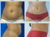 Tummy Tuck with Dr. Kenneth Benjamin Hughes in Los Angeles 29