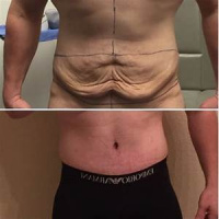 Male tummy tuck with Dr. Kenneth Benjamin Hughes in Los Angeles 12
