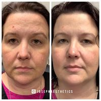 Botox forehean wrinkles and crow's feet before/after 12