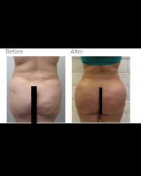 Liposuction and Brazilian buttlift with dead fat or fat death removal with Dr. Kenneth Hughes 37