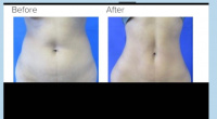 Liposuction with Dr. Kenneth Hughes in Los Angeles 36