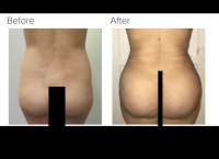 Liposuction and Brazilian buttlift or BBL Revision with Dr. Kenneth Hughes 39