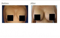 Breast Augmentation with Silicone Breast Implants or Breast Fat Transfer with Dr. Kenneth Hughes 40