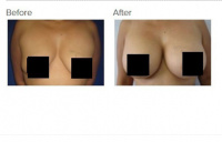 Breast Augmentation with Silicone Breast Implants or Breast Fat Transfer with Dr. Kenneth Hughes 43