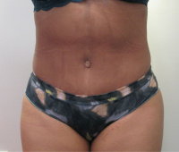 Tummy Tuck with Dr. Kenneth Hughes 48