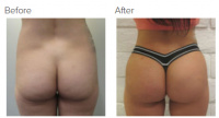 Brazilian Butt Lift with Dr. Kenneth Hughes 46