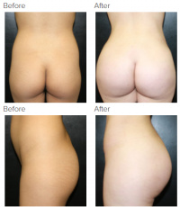 Brazilian Butt Lift Los Angeles with Dr. Kenneth Hughes 44