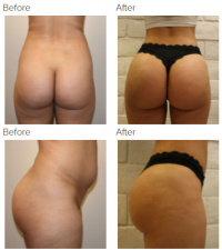 Brazilian Butt Lift Los Angeles with Dr. Kenneth Hughes 46