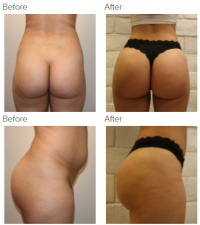 Petite BBL (BMI 22)Brazilian Butt Lift with Lipo360 in Beverly