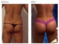 Brazilian Butt Lift Los Angeles with Dr. Kenneth Hughes 50