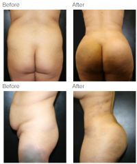 Brazilian Butt Lift Los Angeles with Dr. Kenneth Hughes 51