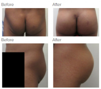 Butt Implants Los Angeles with Dr. Kenneth Hughes 63