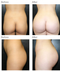 Liposuction Los Angeles with Dr. Kenneth Hughes 78