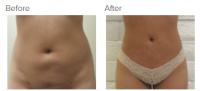 Liposuction Revision & Cellulite Reduction Los Angeles with Dr. Kenneth Hughes 85