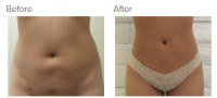 Liposuction Revision & Cellulite Reduction Los Angeles with Dr. Kenneth Hughes 77