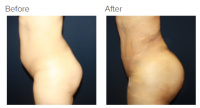 Liposuction Revision & Cellulite Reduction Los Angeles with Dr. Kenneth Hughes 87