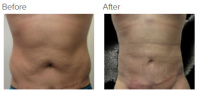 Liposuction Revision & Cellulite Reduction Los Angeles with Dr. Kenneth Hughes 88