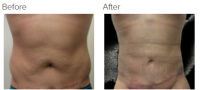 Liposuction Revision & Cellulite Reduction Los Angeles with Dr. Kenneth Hughes 79