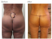 Liposuction Revision & Cellulite Reduction Los Angeles with Dr. Kenneth Hughes 89