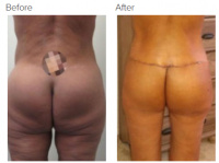 Liposuction Revision & Cellulite Reduction Los Angeles with Dr. Kenneth Hughes 80