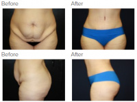 Tummy Tuck Los Angeles with Dr. Kenneth Benjamin Hughes 97