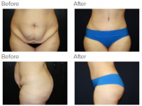 Tummy Tuck Los Angeles with Dr. Kenneth Benjamin Hughes 88