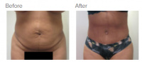 Tummy Tuck Los Angeles with Dr. Kenneth Hughes 89