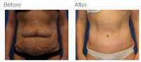 Tummy Tuck Los Angeles with Dr. Kenneth Benjamin Hughes 99