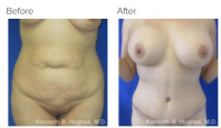 Tummy Tuck Los Angeles with Dr. Kenneth Hughes 91