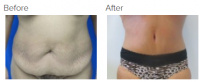 Tummy Tuck Los Angeles with Dr. Kenneth Hughes 101