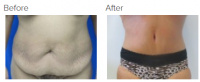 Tummy Tuck Los Angeles with Dr. Kenneth Hughes 92