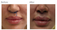 Lip Lift Los Angeles with Dr. Kenneth Hughes 105