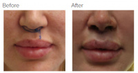 Lip Lift Los Angeles with Dr. Kenneth Hughes 96