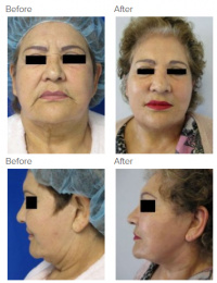 Brow Lift Los Angeles with Dr. Kenneth Hughes 106