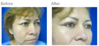 Eyelid Surgery Los Angeles with Dr. Kenneth Hughes 109