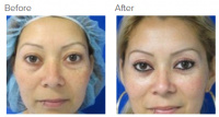Eyelid Surgery Los Angeles with Dr. Kenneth Hughes 110