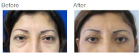 Eyelid Surgery Los Angeles with Dr. Kenneth Hughes 102