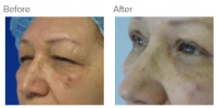 Eyelid Surgery Los Angeles with Dr. Kenneth Hughes 103