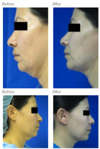 Neck Lift Los Angeles with Dr. Kenneth Hughes 117