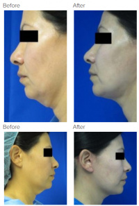 Neck Lift Los Angeles with Dr. Kenneth Hughes 108