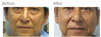 Facial Grafting and Stem Cell Rejuvenation Los Angeles with Dr. Kenneth Hughes 123