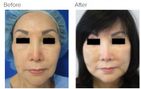 Facial Grafting and Stem Cell Rejuvenation Los Angeles with Dr. Kenneth Hughes 112