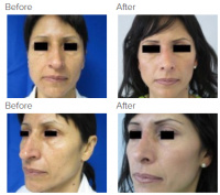 Rhinoplasty Los Angeles with Dr. Kenneth Hughes 129