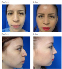 Rhinoplasty with Dr. Kenneth Benjamin Hughes 133