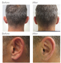 Ear Correction with Dr. Kenneth Hughes 136