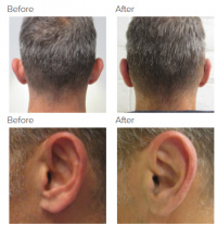 Ear Correction with Dr. Kenneth Hughes 117