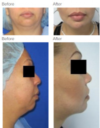 Chin Implant and Chin Liposuction with Dr. Kenneth Benjamin Hughes 142