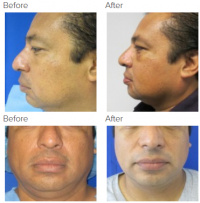 Chin Implant with Dr. Kenneth Hughes 121