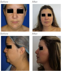 Rhinoplasty, Chin Implant, Chin Liposuction with Dr. Kenneth Hughes 146