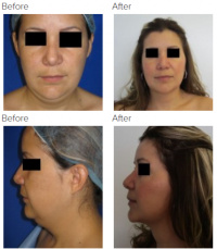 Rhinoplasty, Chin Implant, Chin Liposuction with Dr. Kenneth Hughes 122